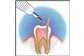 Tratamento de Canal (Endodontia) no Montese